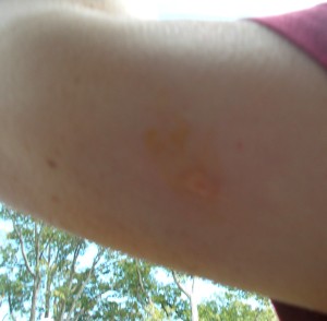 Yep, I got stung by one of the bees.